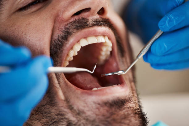 Best Emergency Dental Care for Broken or Chipped Teeth in Lebanon, IN